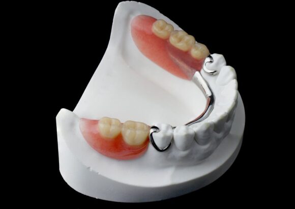 Removable Partial Dentures