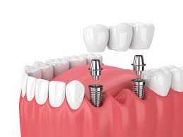 Implants