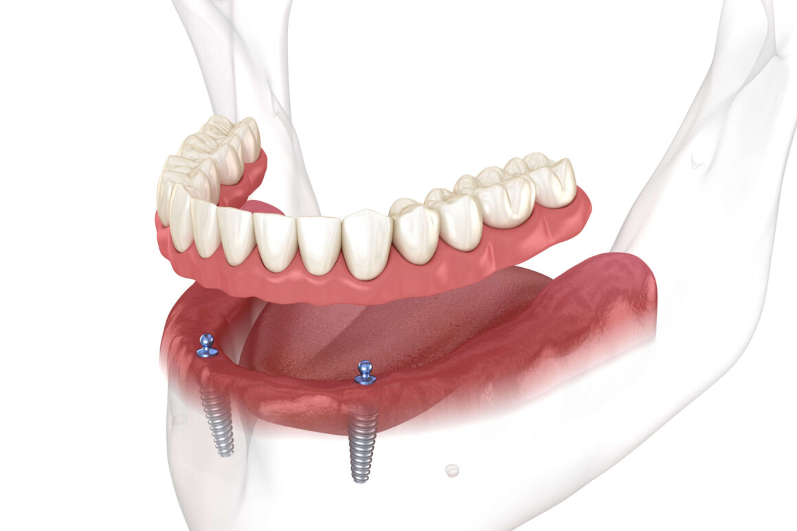 implantoverdenturestock-1-scaled-1 Implant Retained Overdentures