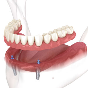 Implant Retained Overdentures