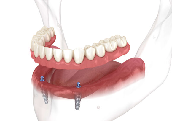 Implant Retained Overdentures