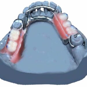 Lower Metal (Chrome) Dentures