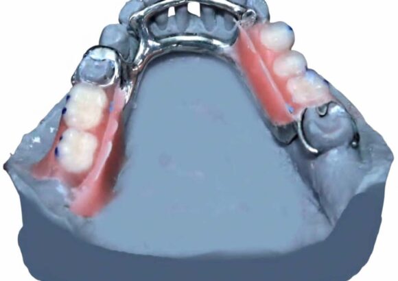 Lower Metal (Chrome) Dentures