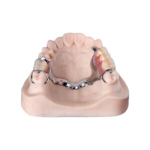 Upper Metal (Chrome) Dentures