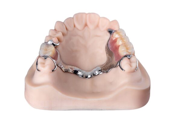 Upper Metal (Chrome) Dentures