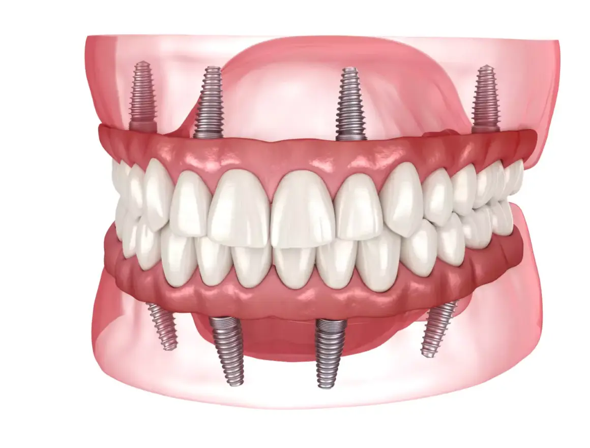 pic-1-all-on-4-6-64e1d10fe184e All on 4 & 6 implants
