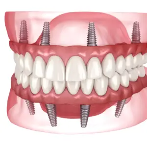 All on 4 & 6 implants