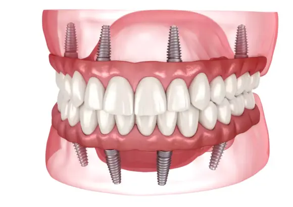 All on 4 & 6 implants